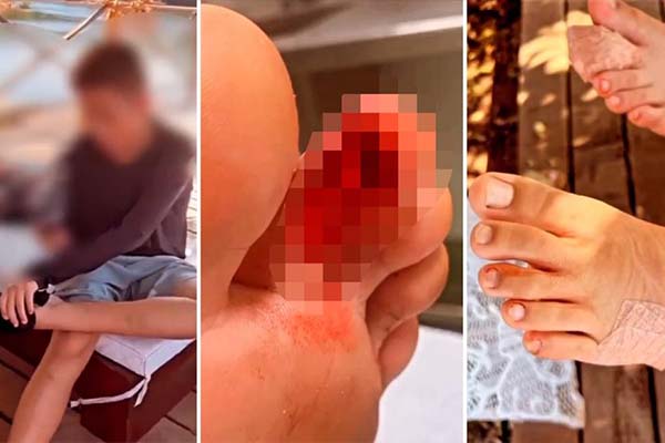 Crianças são atacadas por piranhas em lago de MT; uma teve infecção