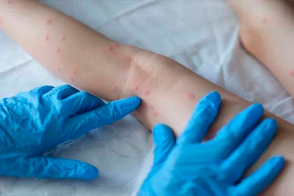 Mato Grosso tem dois novos casos positivos de Varíola dos Macacos