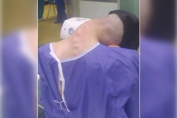 Homem tem síndrome da cabeça caída causada por vício