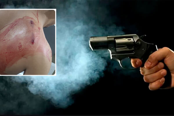 Após-ser-alvejado-nas-costas-em-borracharia