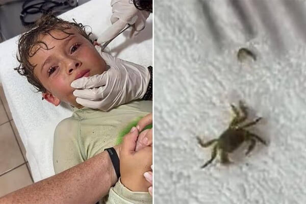 Menino-tem-caranguejo-vivo-retirado-de-ouvido