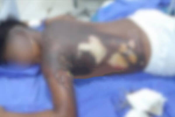 Pai-acusa-vizinho-de-queimar-seu-filho-por-vingança-em-MT