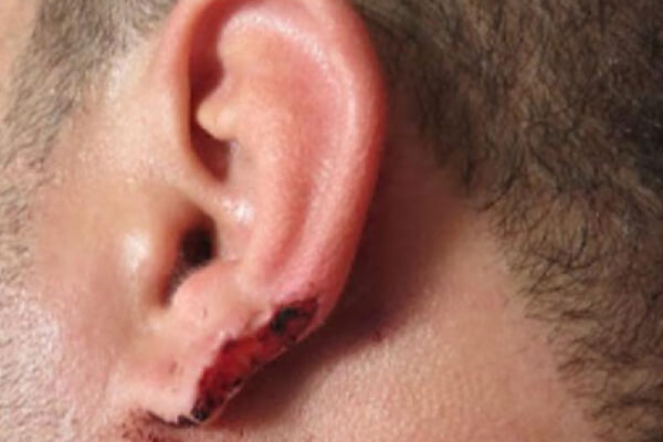 Homem-morde-orelha-de-atirador-e-usa-pedaço